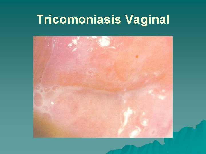 Tricomoniasis Vaginal 