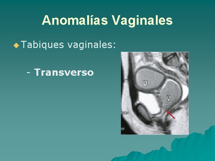Anomalías Vaginales u Tabiques vaginales: - Transverso 
