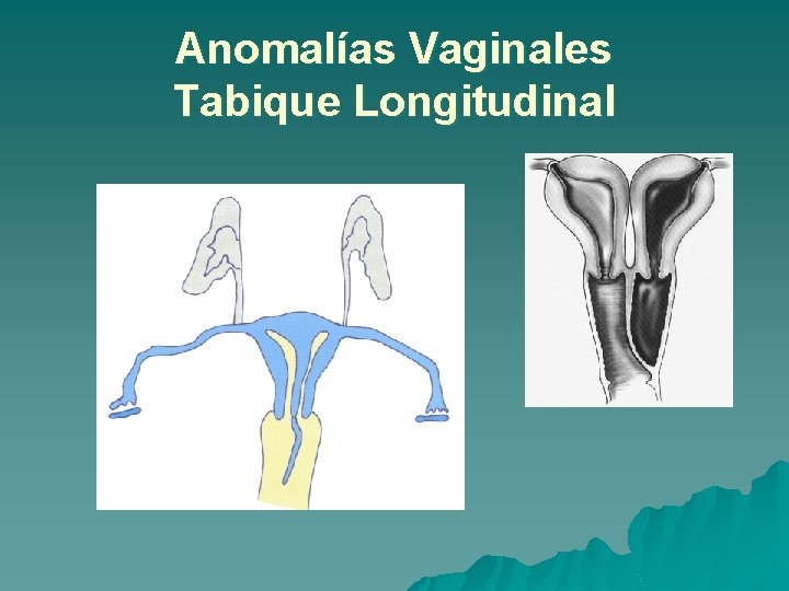 Anomalías Vaginales Tabique Longitudinal 
