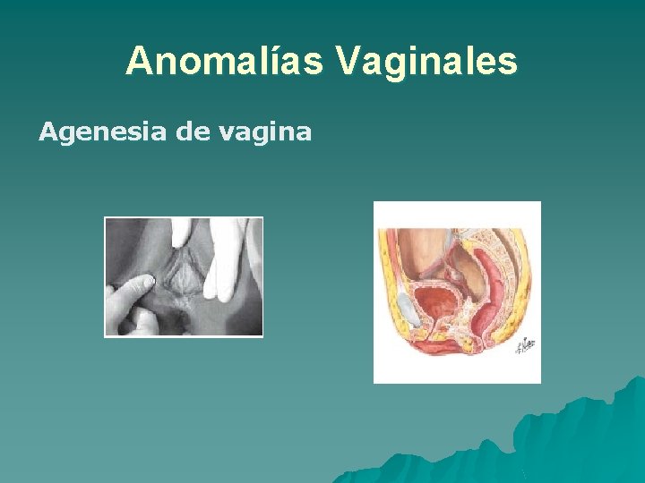 Anomalías Vaginales Agenesia de vagina 