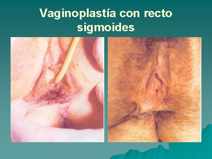 Vaginoplastía con recto sigmoides 