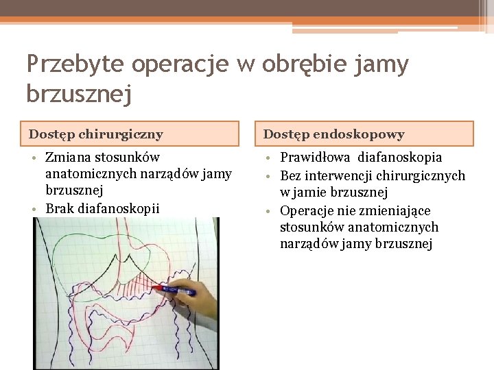 Przebyte operacje w obrębie jamy brzusznej Dostęp chirurgiczny Dostęp endoskopowy • Zmiana stosunków anatomicznych