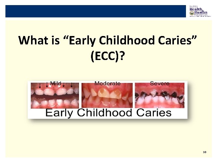 What is “Early Childhood Caries” (ECC)? 10 