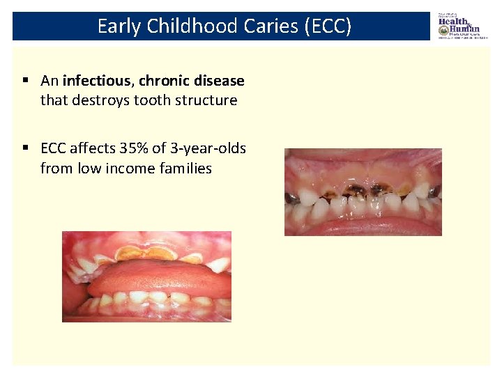 Early Childhood Caries (ECC) § An infectious, chronic disease that destroys tooth structure §
