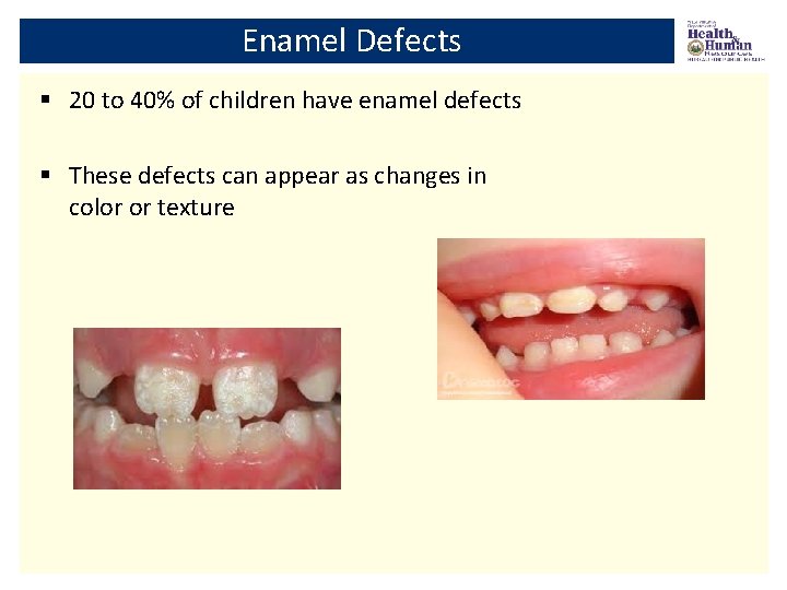 Enamel Defects § 20 to 40% of children have enamel defects § These defects