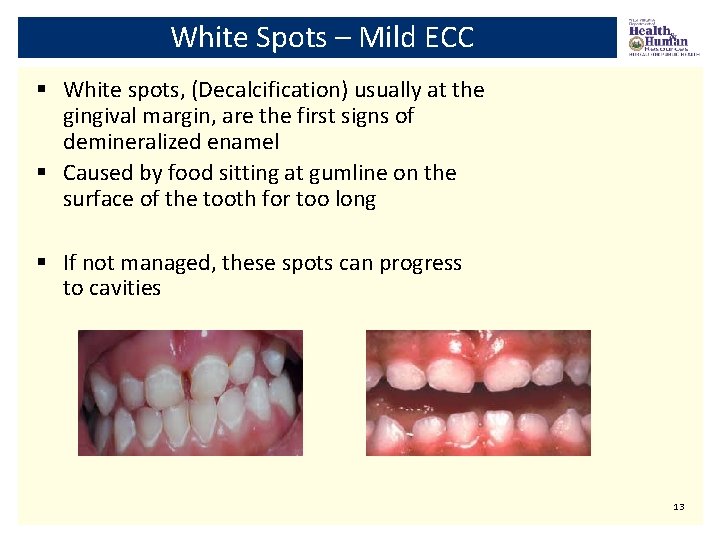White Spots – Mild ECC § White spots, (Decalcification) usually at the gingival margin,