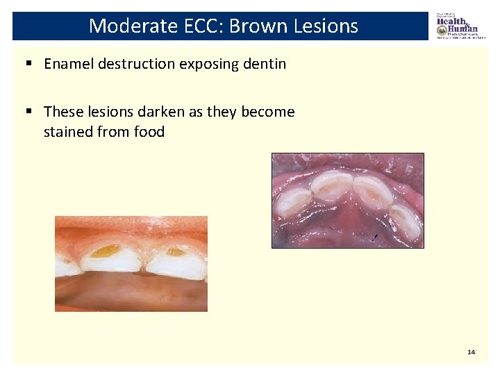 Moderate ECC: Brown Lesions § Enamel destruction exposing dentin § These lesions darken as