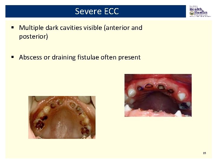 Severe ECC § Multiple dark cavities visible (anterior and posterior) § Abscess or draining