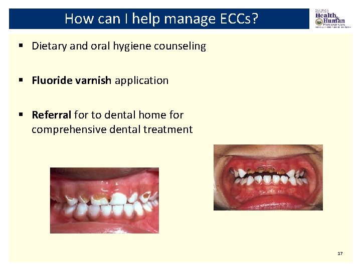 How can I help manage ECCs? § Dietary and oral hygiene counseling § Fluoride