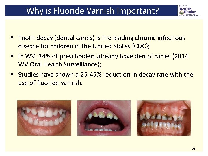 Why is Fluoride Varnish Important? § Tooth decay (dental caries) is the leading chronic