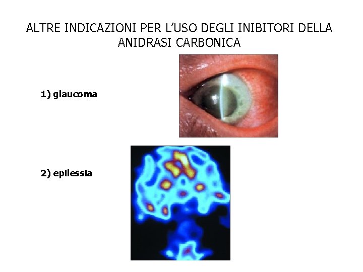 ALTRE INDICAZIONI PER L’USO DEGLI INIBITORI DELLA ANIDRASI CARBONICA 1) glaucoma 2) epilessia 