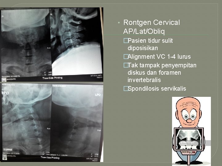  • Rontgen Cervical AP/Lat/Obliq �Pasien tidur sulit diposisikan �Alignment VC 1 -4 lurus