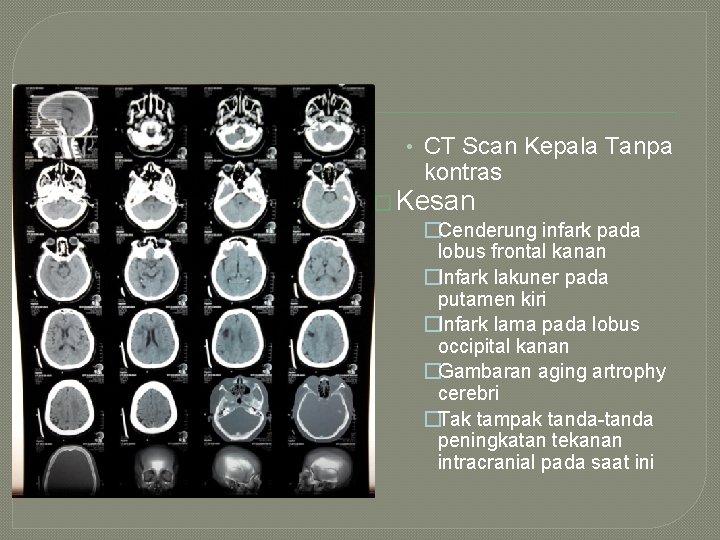  • CT Scan Kepala Tanpa kontras � Kesan �Cenderung infark pada lobus frontal