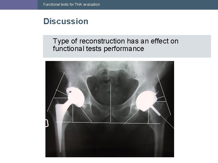 Functional tests for THA evaluation Discussion Type of reconstruction has an effect on functional Functional tests for THA evaluation Discussion Type of reconstruction has an effect on functional