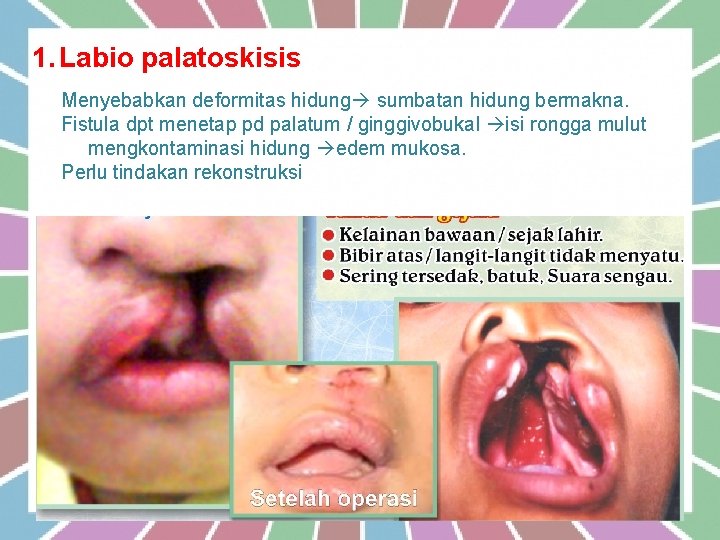 1. Labio palatoskisis Menyebabkan deformitas hidung sumbatan hidung bermakna. Fistula dpt menetap pd palatum