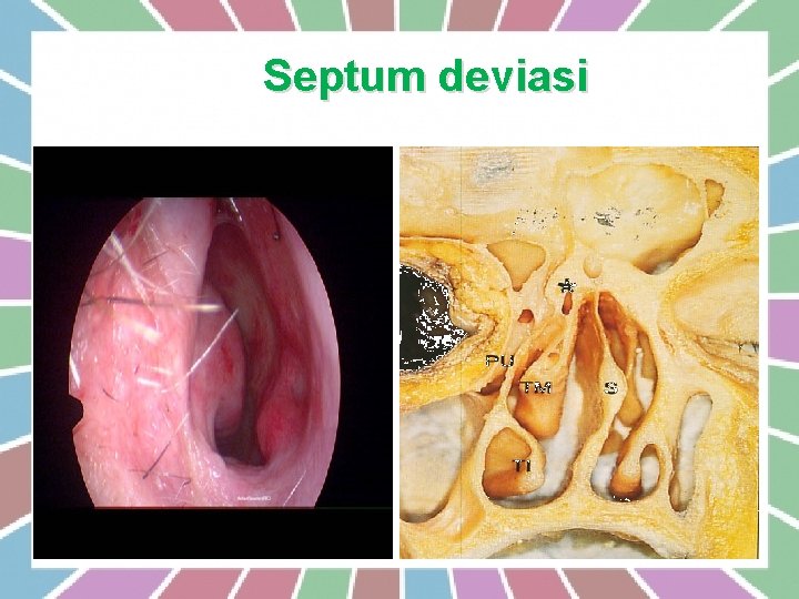 Septum deviasi 