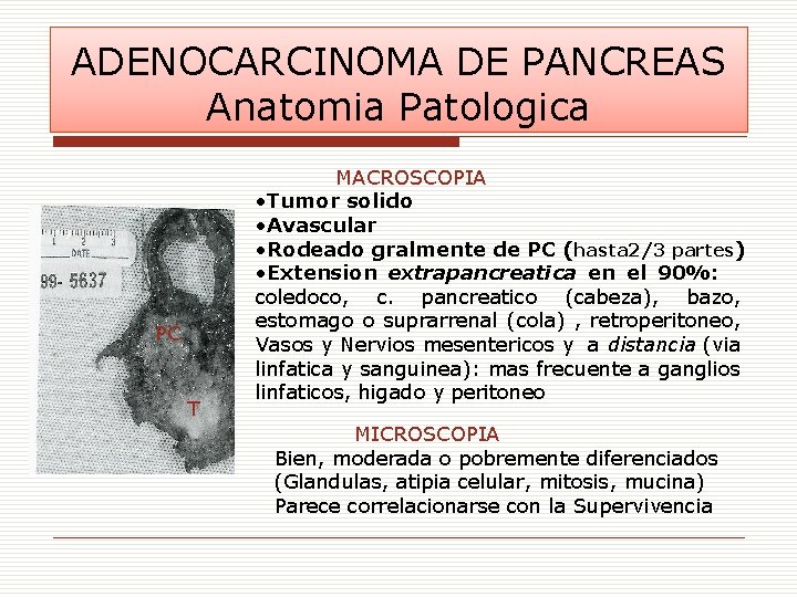 ADENOCARCINOMA DE PANCREAS Anatomia Patologica PC T MACROSCOPIA • Tumor solido • Avascular •