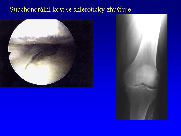 subchondrální kost inflamația articulațiilor din partea inferioară a spatelui