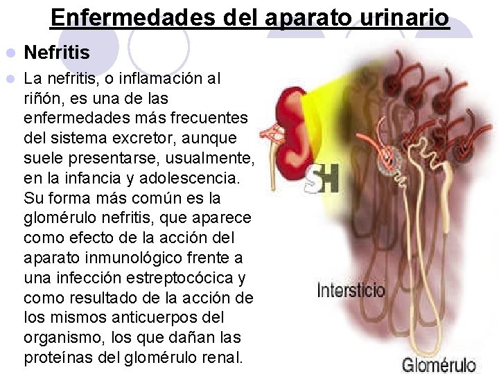 Enfermedades del aparato urinario l Nefritis l La nefritis, o inflamación al riñón, es