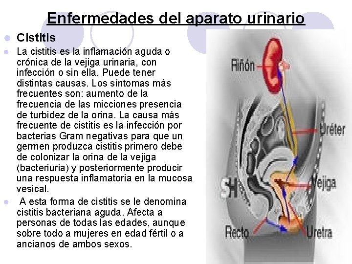 Enfermedades del aparato urinario l Cistitis La cistitis es la inflamación aguda o crónica