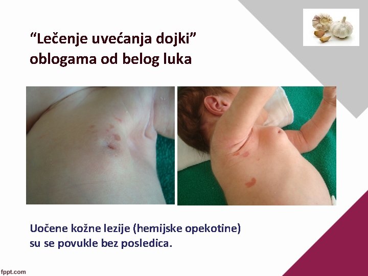 “Lečenje uvećanja dojki” oblogama od belog luka Uočene kožne lezije (hemijske opekotine) su se