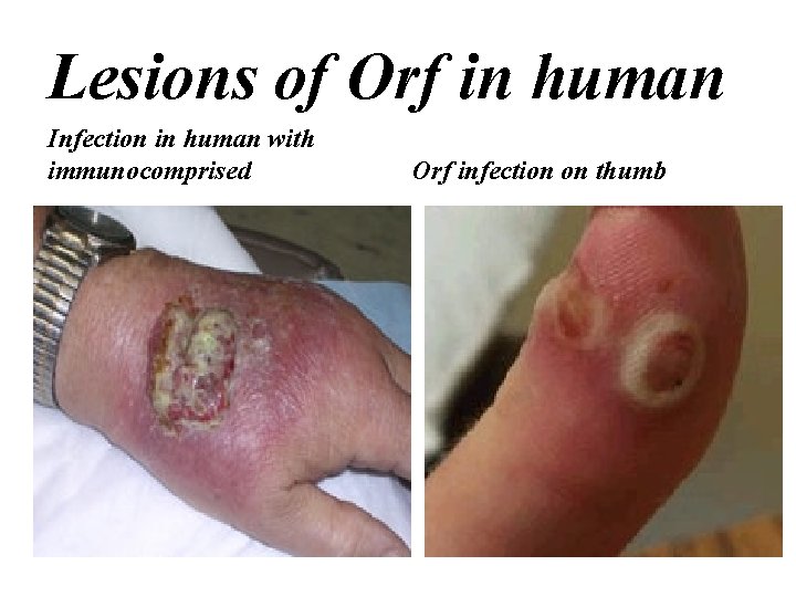 Lesions of Orf in human Infection in human with immunocomprised Orf infection on thumb