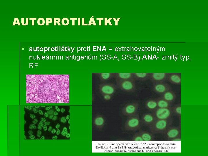 AUTOPROTILÁTKY § autoprotilátky proti ENA = extrahovatelným nukleárním antigenům (SS-A, SS-B), ANA- zrnitý typ,