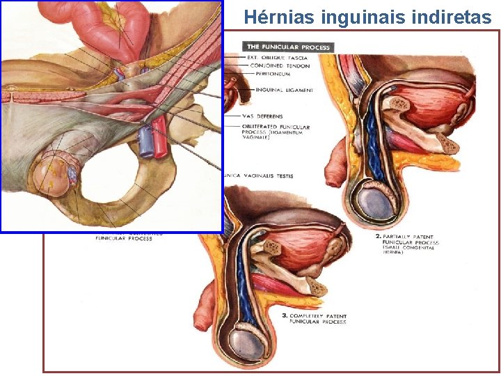 Hérnias inguinais indiretas 