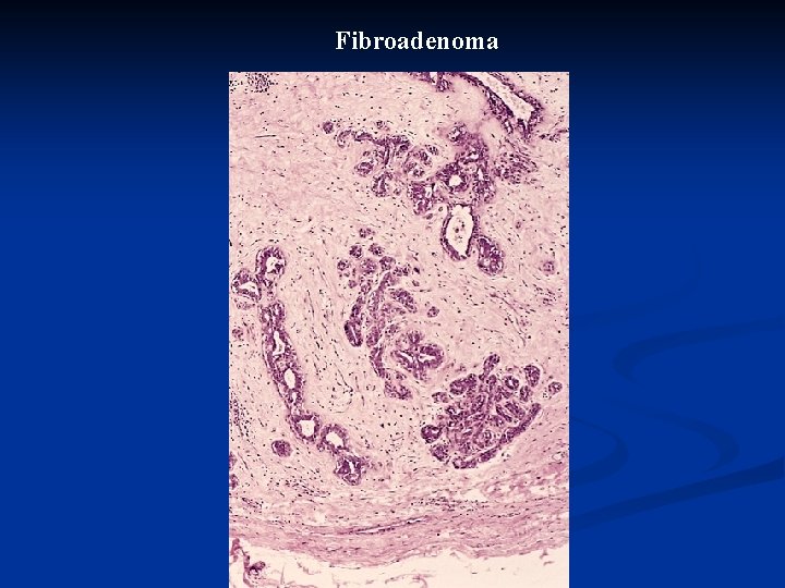Fibroadenoma 