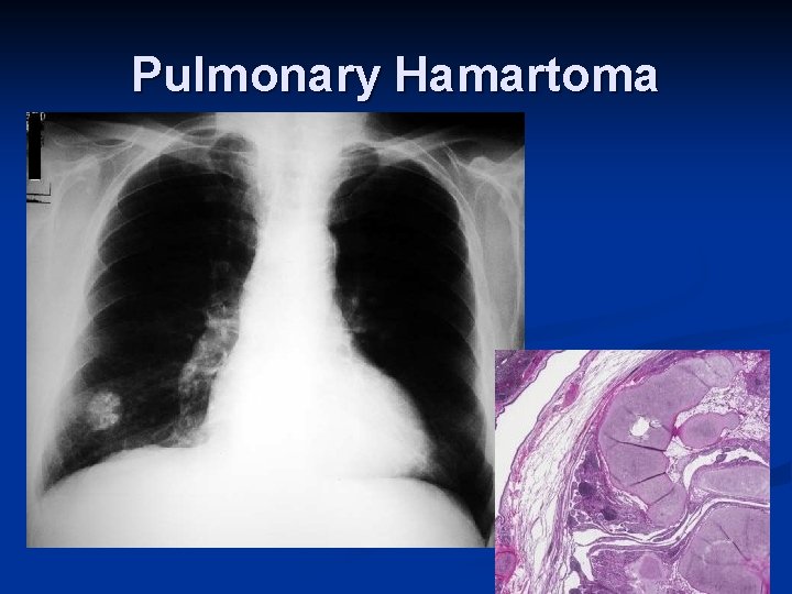 Pulmonary Hamartoma 