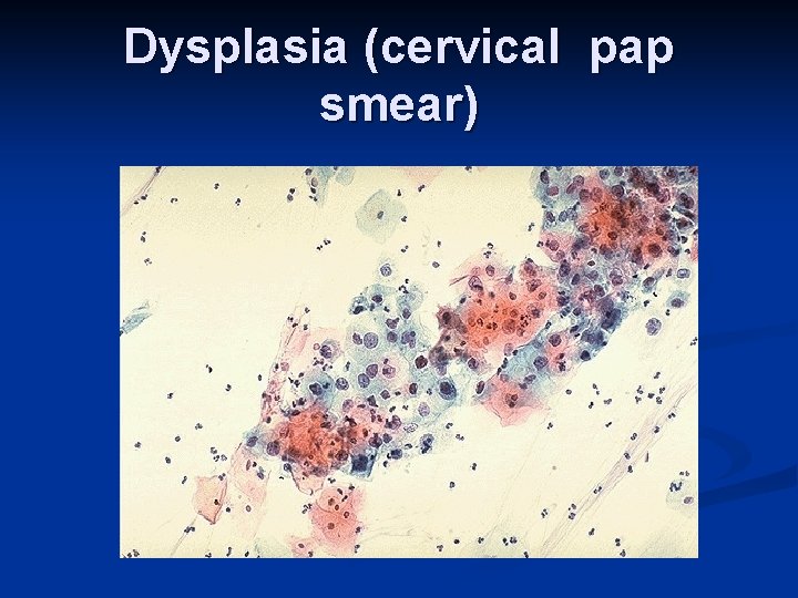 Dysplasia (cervical pap smear) 