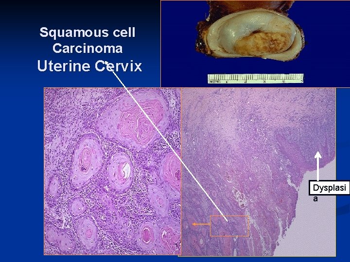 Squamous cell Carcinoma Uterine Cervix Dysplasi a 