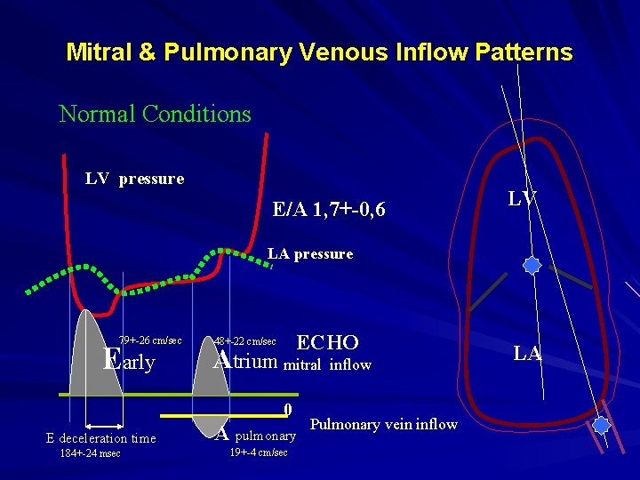 Mitral & Pulmonary Venous Inflow Patterns Normal Conditions LV pressure E/A 1, 7+-0, 6