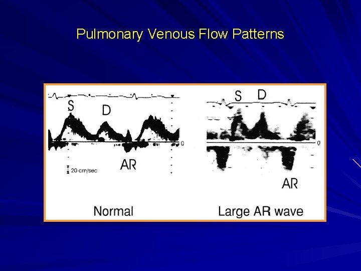 Pulmonary Venous Flow Patterns 