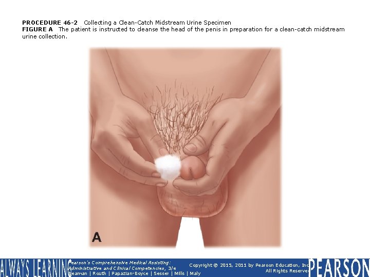 PROCEDURE 46 -2 Collecting a Clean-Catch Midstream Urine Specimen FIGURE A The patient is