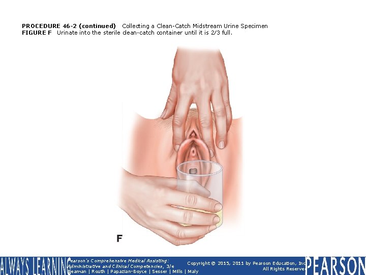 PROCEDURE 46 -2 (continued) Collecting a Clean-Catch Midstream Urine Specimen FIGURE F Urinate into