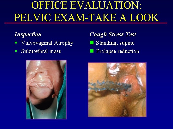 OFFICE EVALUATION: PELVIC EXAM-TAKE A LOOK Inspection Cough Stress Test § Vulvovaginal Atrophy §