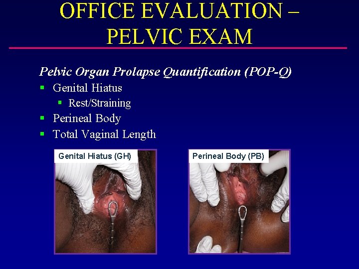 OFFICE EVALUATION – PELVIC EXAM Pelvic Organ Prolapse Quantification (POP-Q) § Genital Hiatus §