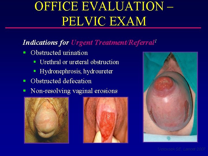 OFFICE EVALUATION – PELVIC EXAM Indications for Urgent Treatment/Referral 1 § Obstructed urination §