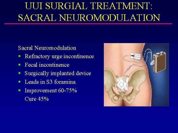 UUI SURGIAL TREATMENT: SACRAL NEUROMODULATION Sacral Neuromodulation § Refractory urge incontinence § Fecal incontinence