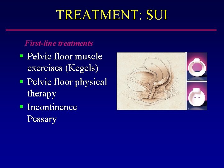 TREATMENT: SUI First-line treatments § Pelvic floor muscle exercises (Kegels) § Pelvic floor physical