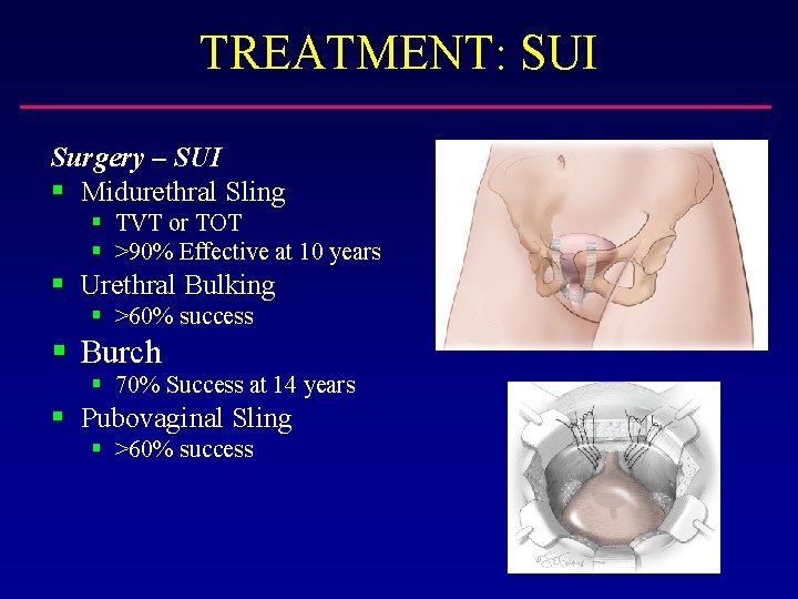 TREATMENT: SUI Surgery – SUI § Midurethral Sling § TVT or TOT § >90%