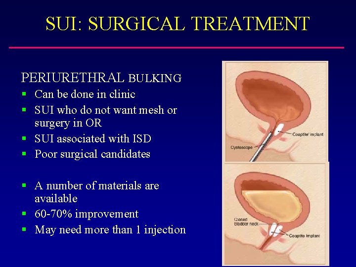 SUI: SURGICAL TREATMENT PERIURETHRAL BULKING § Can be done in clinic § SUI who