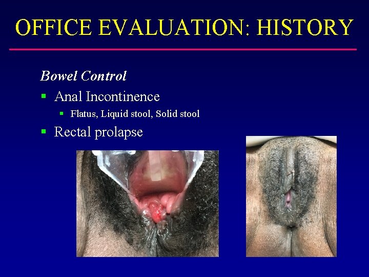 OFFICE EVALUATION: HISTORY Bowel Control § Anal Incontinence § Flatus, Liquid stool, Solid stool