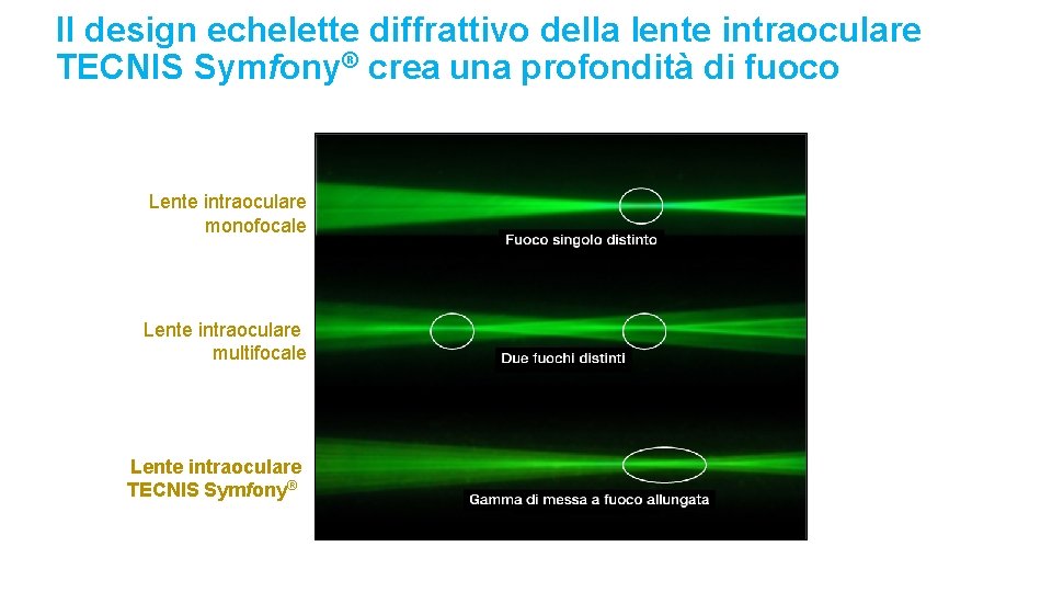 Il design echelette diffrattivo della lente intraoculare TECNIS Symfony® crea una profondità di fuoco