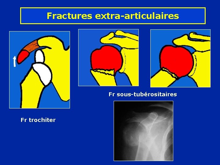 Fractures extra-articulaires Fr sous-tubérositaires Fr trochiter 