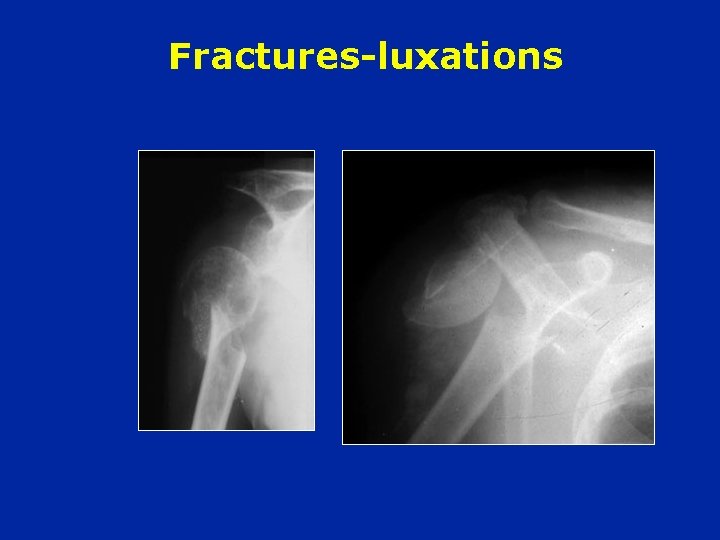 Fractures-luxations 