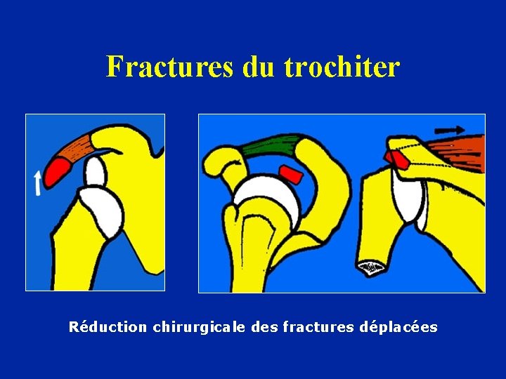 Fractures du trochiter Réduction chirurgicale des fractures déplacées 