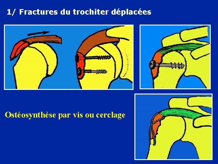 1/ Fractures du trochiter déplacées Ostéosynthèse par vis ou cerclage 