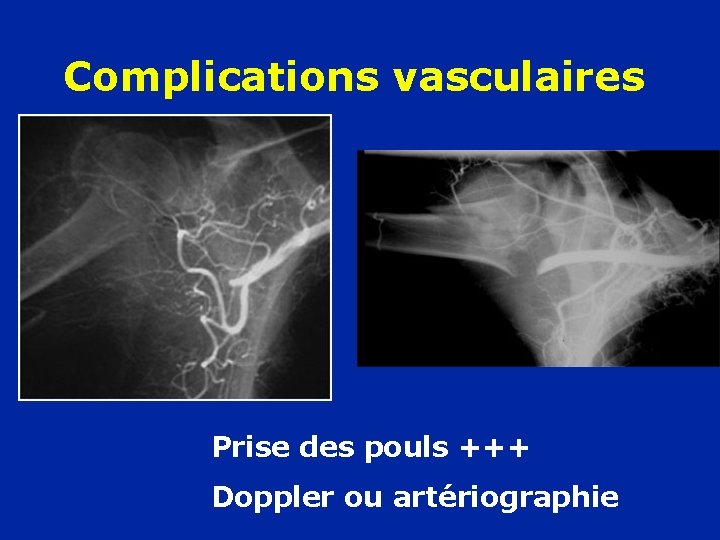 Complications vasculaires Prise des pouls +++ Doppler ou artériographie 
